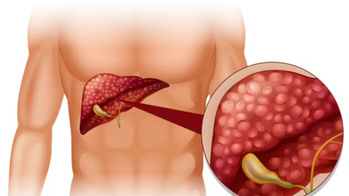 Ayurvedic Tips to Fatty Liver