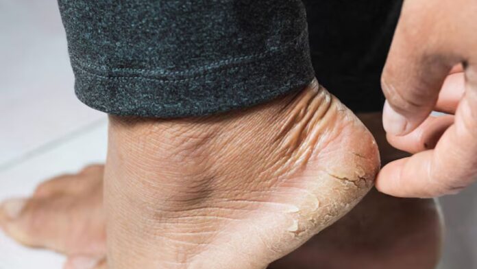 Cracked Heel Home Remedy