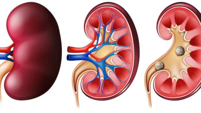 Early signs of kidney failure