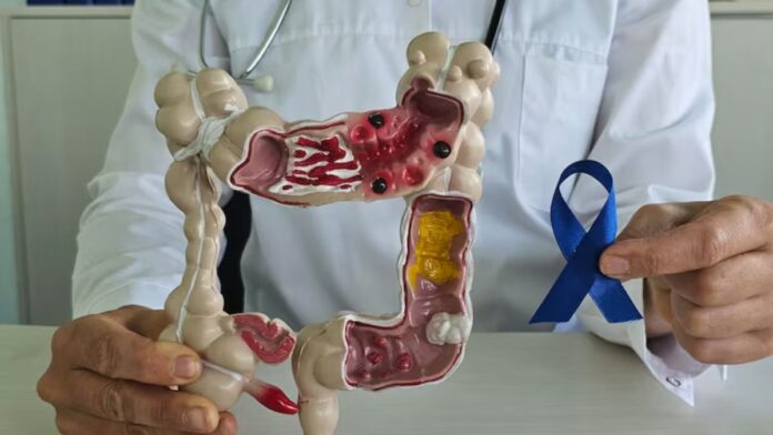 How Gut Bacteria Cause Colon Cancer