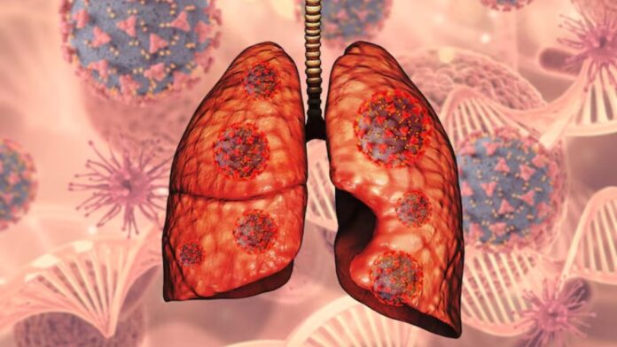 Lung Cancer Risk After Covid