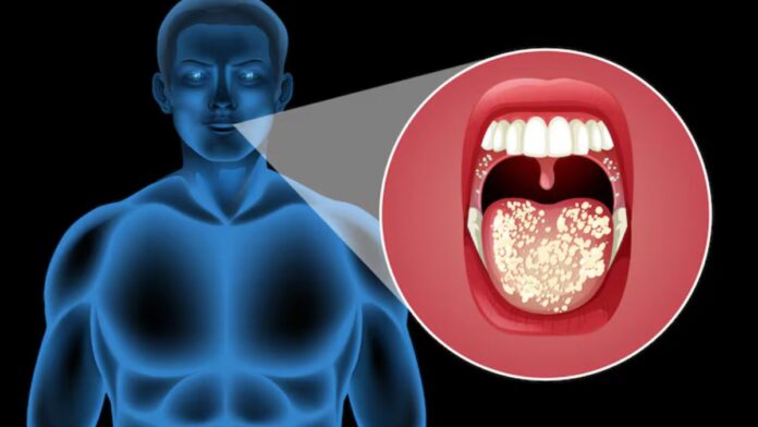 Mouth Cancer Symptoms