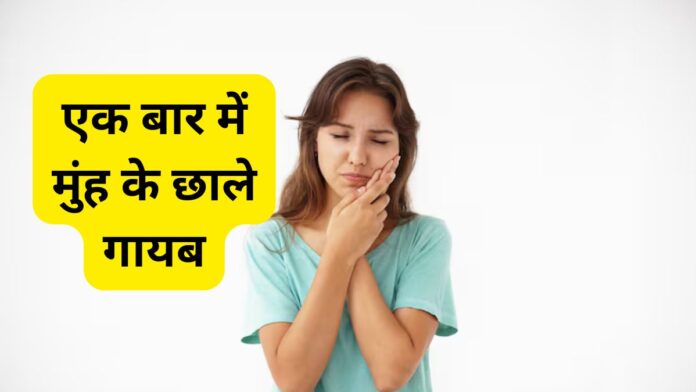 Mouth Ulcers Remedies