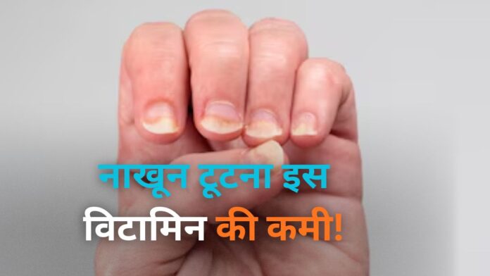 Vitamin B12 Deficiency