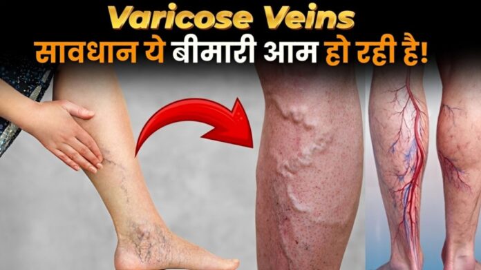 What Is Varicose Veiens