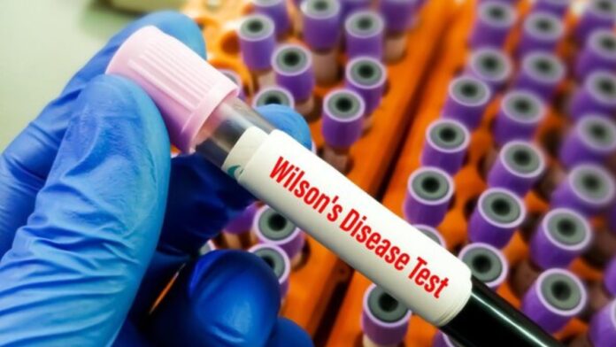 Wilson Disease