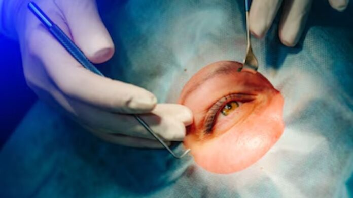 Moolchand Hospital Cataract Surgery