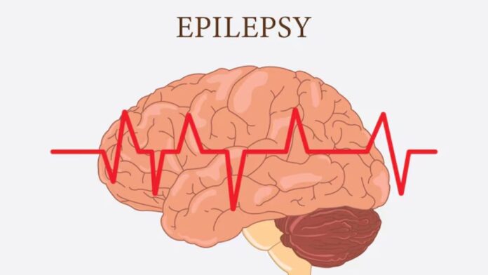 Laughing Epilepsy