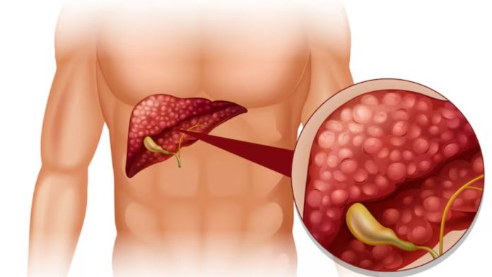 Fatty Liver Cause