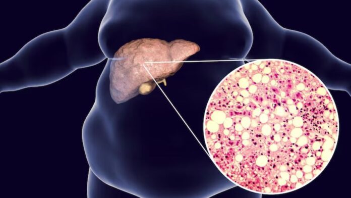 Fatty Liver Cause