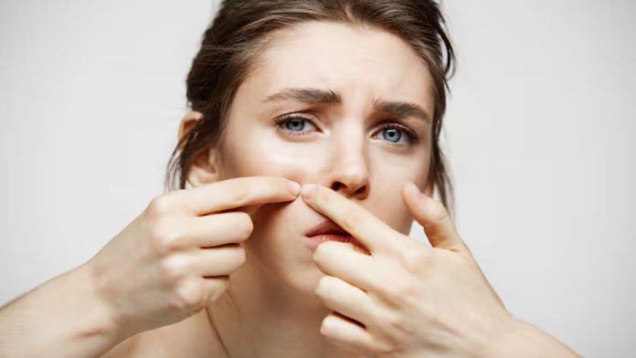 How to prevent summer acne