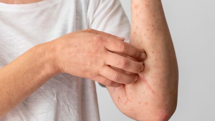 Measles Cases in Chennai