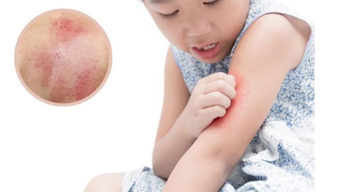 Why do heat rashes occur in the summer