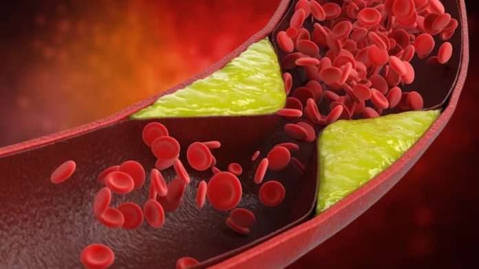 Bad Cholesterol