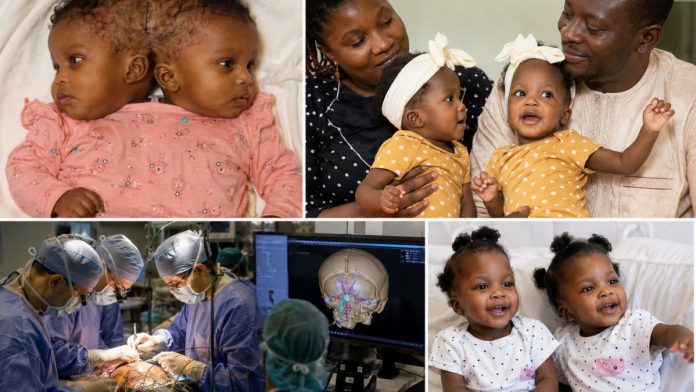 Conjoined twins' separation journey and recovery