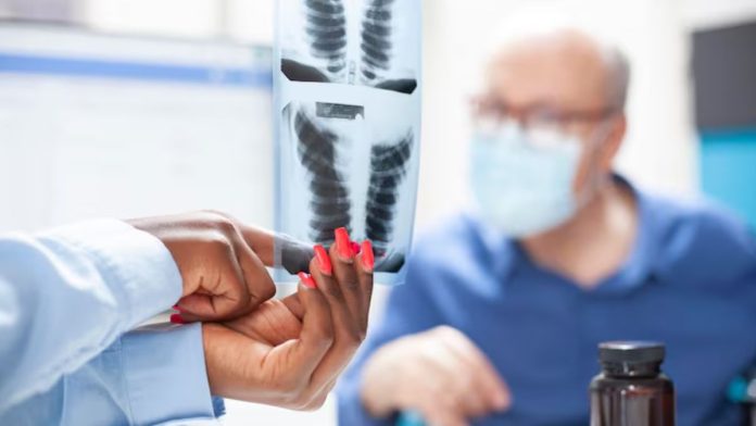 HIV lung transplant