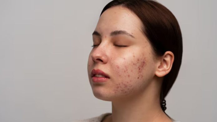 Remedies for Dark Spots: चेहरे के दाग-धब्बे हटाना हो रहा मुश्किल, आजमाएं ये उपाय