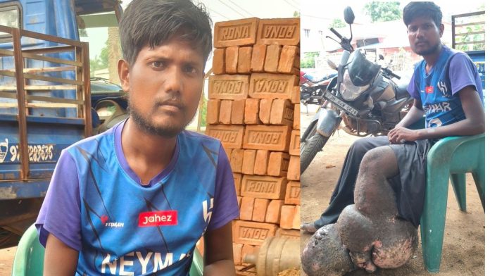 मच्छर के काटने से हाथी जैसा हुआ पांव, जाने क्या है ये बीमारी, 10 साल से पीड़ित ये व्यक्ति