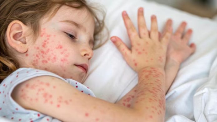 Bangladesh Measles Outbreak