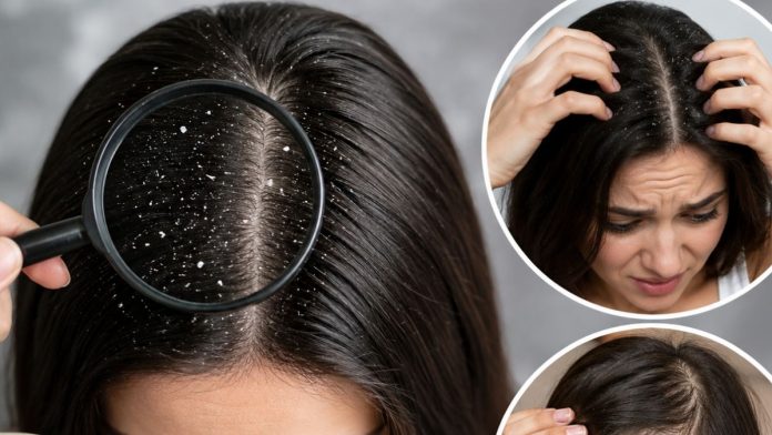Hair Warning Signs: नहीं हट रहा जिद्दी डैंड्रफ, शरीर में हो सकती है ये कमी