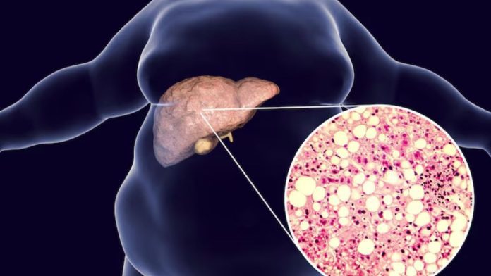 Non-Alcoholic Fatty Liver Disease