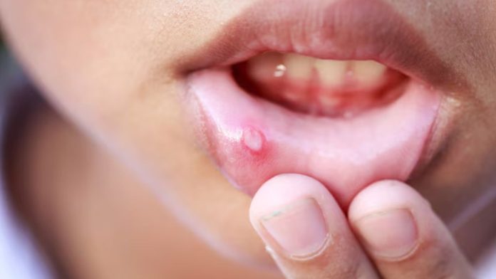 Mouth Ulcers: तुलसी की पत्तियों में मौजूद औषधी गुण छालें की समस्या करेगा कम