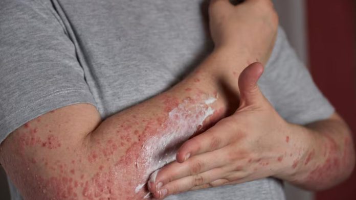 Psoriasis Remedy: सोरायसिस में अपनाएं ये घरेलू उपाय, मिलेगा आराम